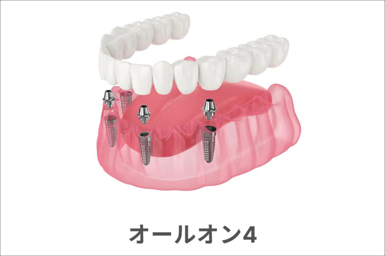 オールオン4のイメージ