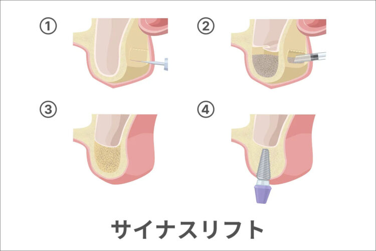 サイナスリフトのイメージ