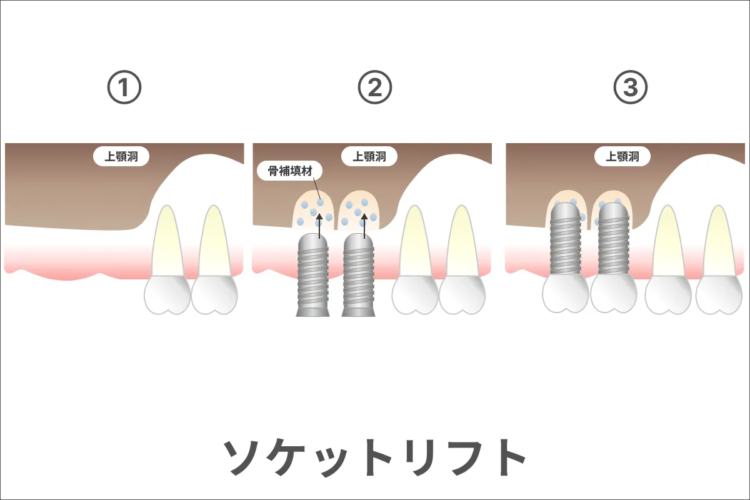 ソケットリフトのイメージ