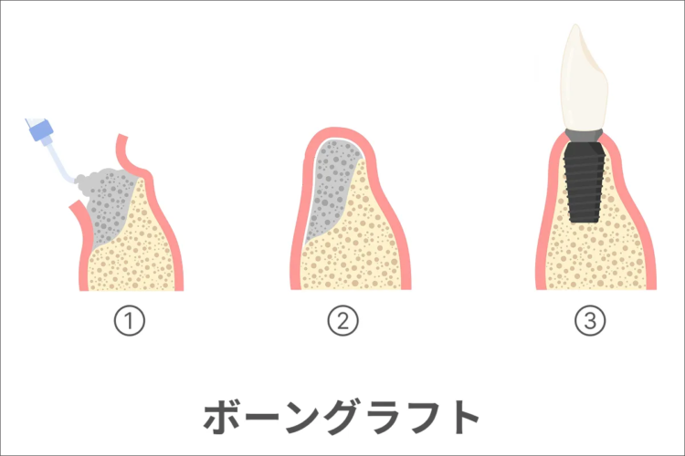 ボーングラフトのイメージ