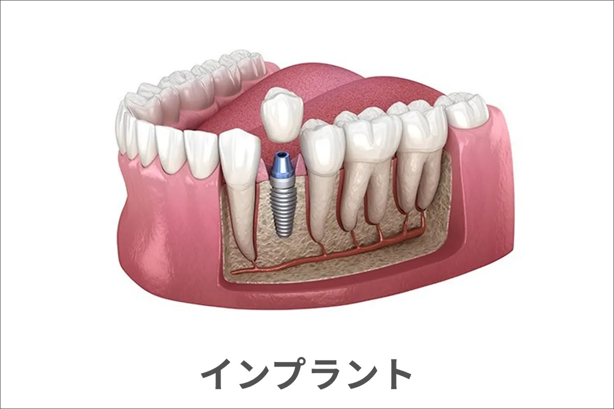 インプラントのイメージ画像