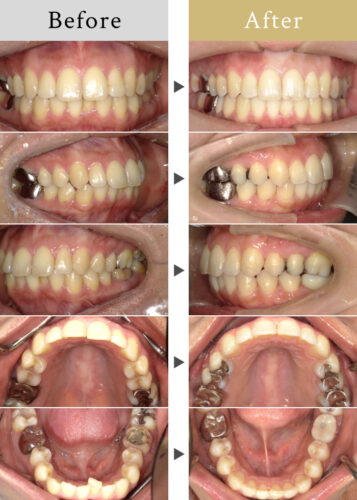 矯正治療による咬合治療を伴ったインプラント治療 | 横浜エス歯科