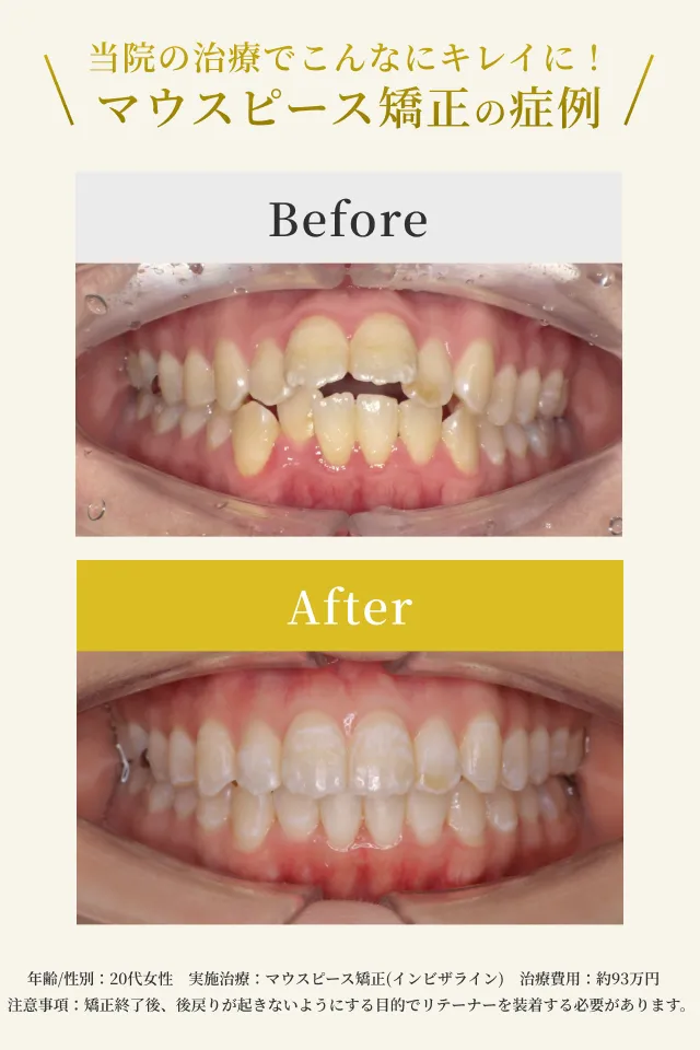 横浜でマウスピース矯正をお探しの方へ｜横浜エス歯科クリニック