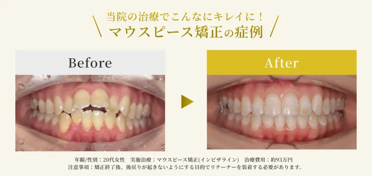 エス歯科クリニックのマウスピース矯正の症例