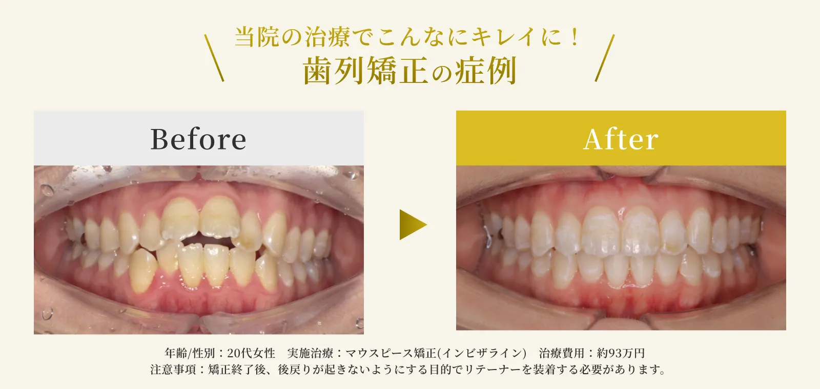 エス歯科クリニックの歯列矯正の症例