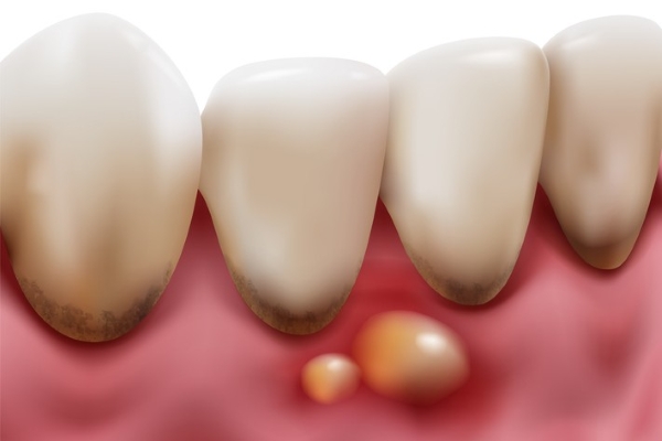 歯茎から膿が出るのはなぜ？原因と治療法、インプラントという選択肢 画像