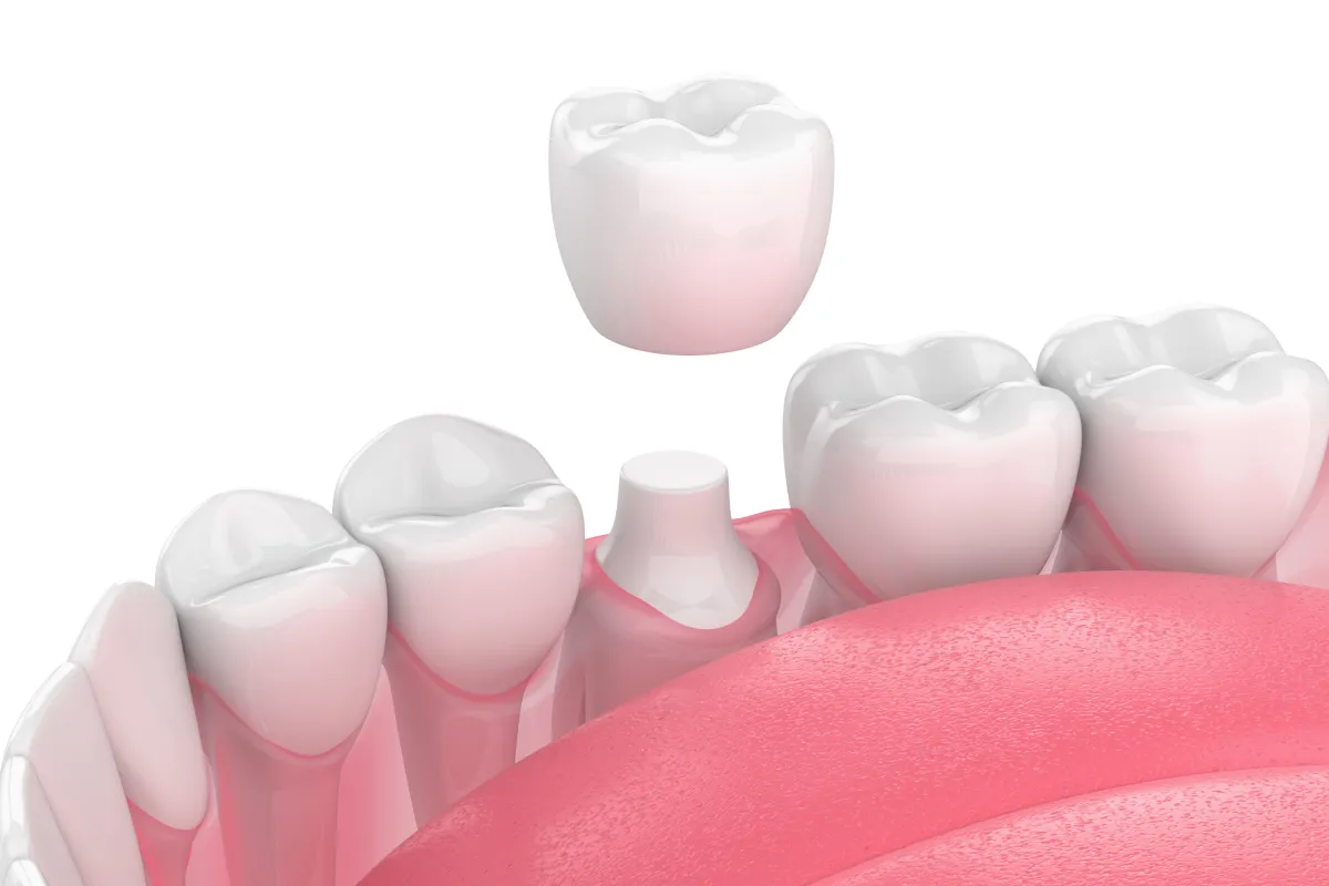 被せ物(クラウン)のイメージ画像