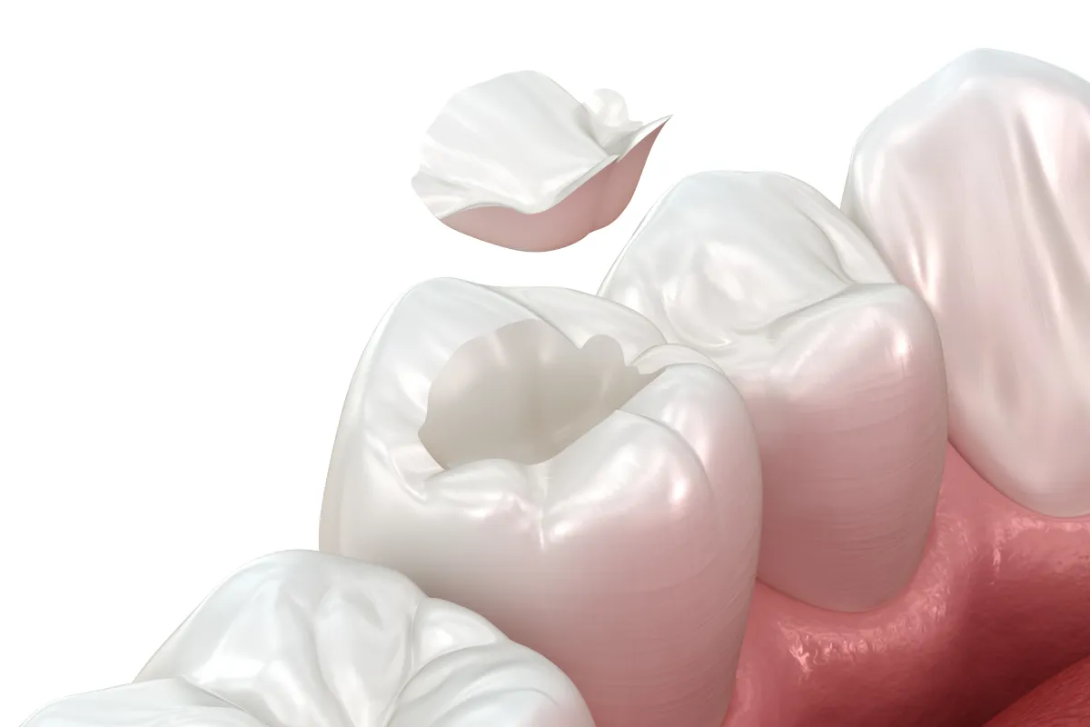 詰め物(インレー)のイメージ写真